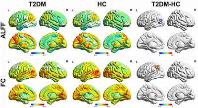 Frontiers | Aberrant Brain Spontaneous Activity And Synchronization In ...